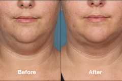 Kybella