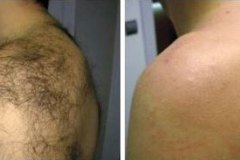 Laser-Hair-1