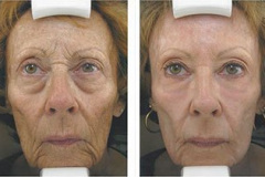 Laser Skin Resurfacing