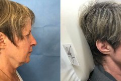 laser-profractional