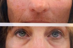 laserskinresurfacing-1