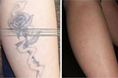 Laser Tattoo Removal