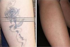Laser-Tattoo-Removal-1
