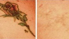 Laser-Tattoo-Removal-2