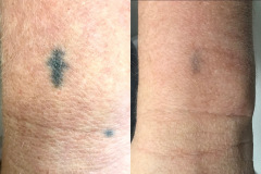 tattoo-removal-ba