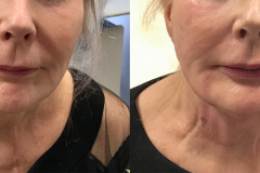 Dermal Fillers