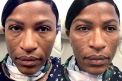 DERMAL FILLERS