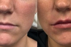 DERMAL FILLERS