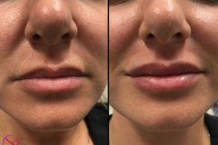 DERMAL FILLERS