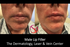DERMAL FILLERS