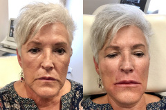 DERMAL FILLERS