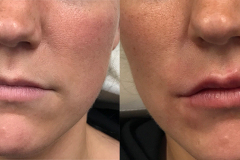 DERMAL FILLERS