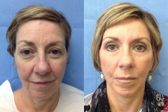 DERMAL FILLERS