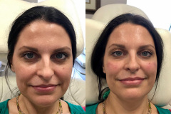 DERMAL FILLERS