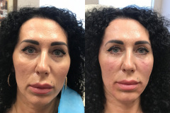 DERMAL FILLERS