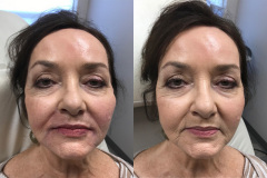 DERMAL FILLERS