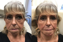 DERMAL FILLERS