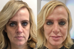 DERMAL FILLERS