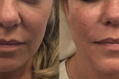 DERMAL FILLERS