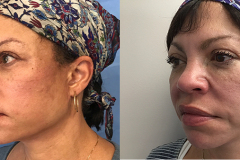 DERMAL FILLERS