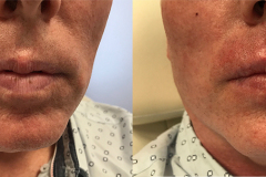 DERMAL FILLERS