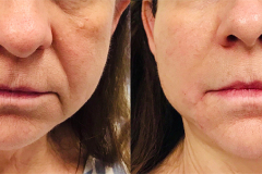 DERMAL FILLERS