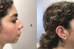 DERMAL FILLERS