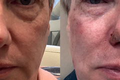 DERMAL FILLERS