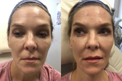 DERMAL FILLERS