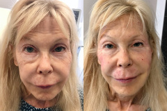 DERMAL FILLERS