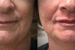 DERMAL FILLERS
