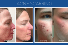 Microneedling