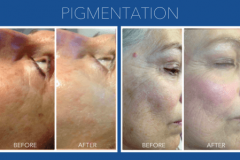 pigmentation-1