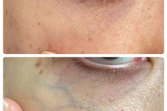 (Nd:YAG) Laser