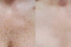 Photodynamic Therapy