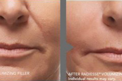 Radiesse
