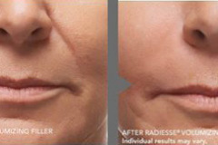 Radiesse Treatment
