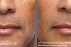 Radiesse Treatment