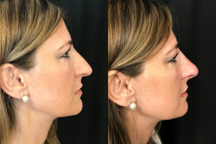 Tinker Bell Nose Lift