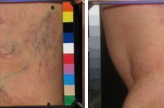 Sclerotherapy 