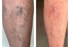 Sclerotherapy-right-after