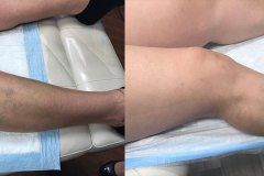 leg-blue-veins