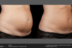 SculpSure
