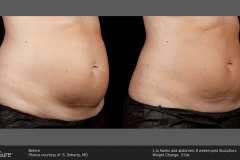 sculpsure-1