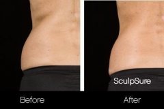 sculpsure-2