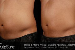 sculpsure-3