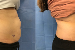 sculpsure-ba