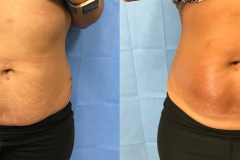 Stretch Marks