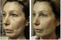 thermage-jaw-line-500x347