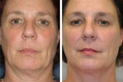 thermage-straka-500x366